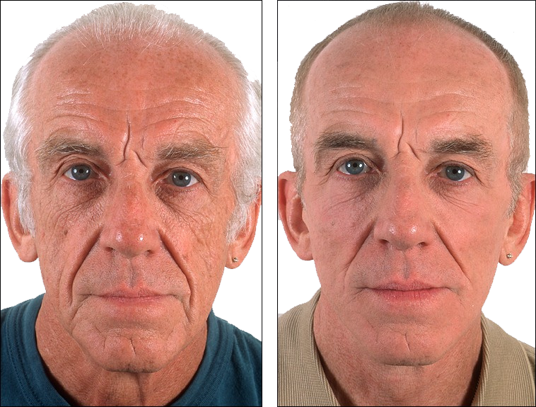 جراحی جوانسازی صورت