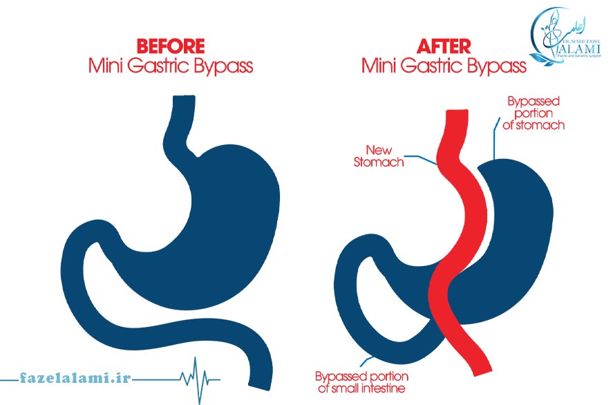 مهم ترین تفاوت بای پس و مینی بای پس چیست؟