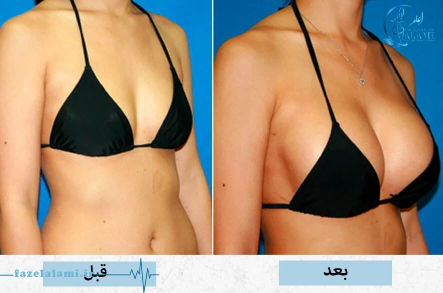 عکس قبل و بعد از عمل ماموپلاستی